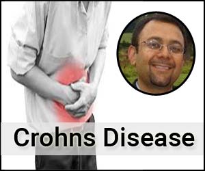 Modern treatment of patient with Crohns Disease