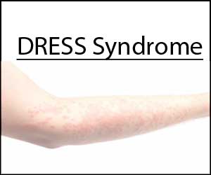 Rare case of Carbamazepine-induced DRESS Syndrome