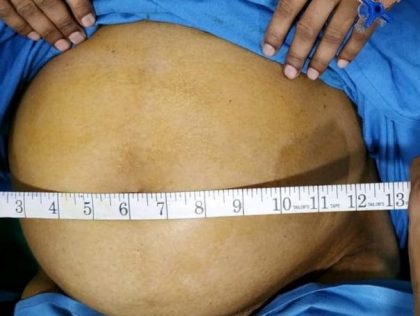 Kalwa hospital doctors remove gaint 6 kg fibroid from womens uterus