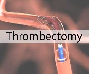 Procedure time of 30 to 60 minutes vital for thrombectomy success in Stroke