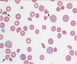 Rare case of Thrombotic Thrombocytopenic Purpura: Case report