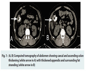 Rare case of acute fulminant necrotizing amebic colitis with lower GI bleeding