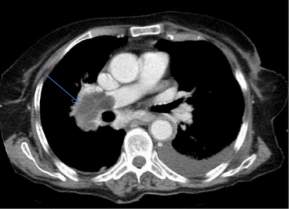 An unusual case of Hydatid Cyst in the Pulmonary Artery