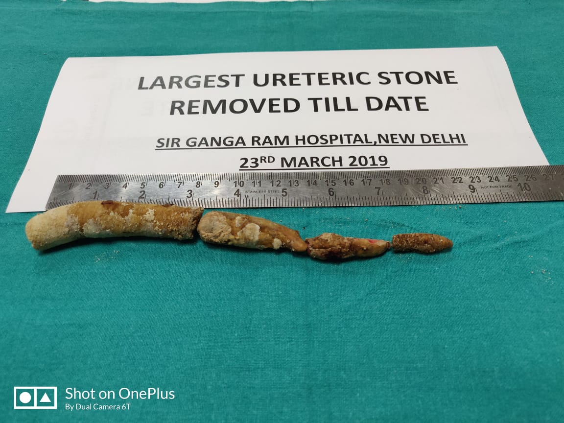 Ureteric stone measuring 22 cm removed at Sir Ganga Ram Hospital, largest in World