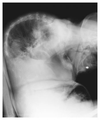 Osteoporosis leading to vertebral fracture and Kyphosis: Case Study