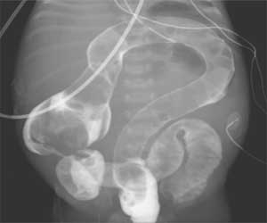Baby born with colon having appearnce of question-mark: NEJM case report