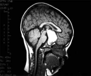 Proton therapy may protect memory function in children with brain tumor