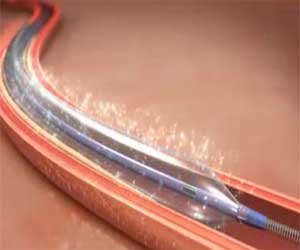 Drug Coated Balloons safer than Drug Eluting Stents for small vessel coronary artery disease, confirms a BASKET-SMALL 2 trial