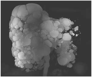 Case of Liver Involvement in Polycystic Kidney Disease reported in NEJM