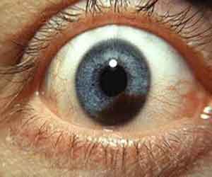 Case of Metastatic Uveal Melanoma reported in NEJM