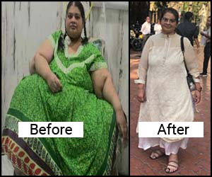 Indian doctors help Asia’s heaviest woman lose 214 kgs through weight loss surgery