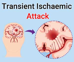 Managing transient ischaemic attack in first 48 hrs: NICE 2019 Guidelines