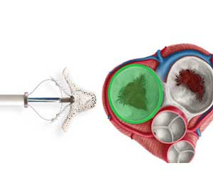 Clip repair of tricuspid valve improves quality of life: TRILUMINATE trial