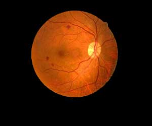 Sleep apnea in diabetes increases macular edema risk