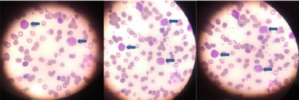Case of B-cell leukemia presented as inflammatory arthritis: JAPI Case Report