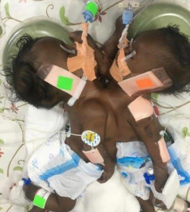 Narayana surgeons perform World’s first PDA Stenting on Mauritian Conjoined Twins with Shared Heart