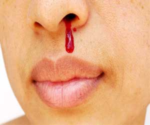 Tranexamic acid as good as nasal tampon for stopping nose bleeding