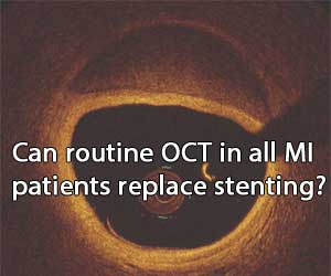 Should OCT be done routinely in MI Patients- Experts Opine