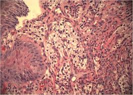 Rare presentation of renal cell cancer as dysphagia: Case report