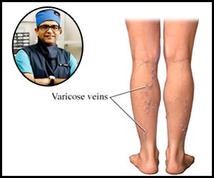 Treating varicose veins with laser treatment- Dr Bhavesh Arun Popat