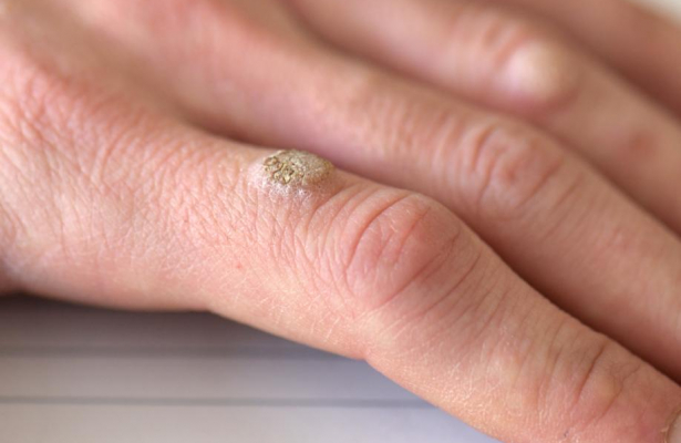 Epicutaneous heat patch  safe and effective treatment of Warts