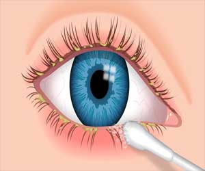 Permethrin cream safe and effective for treatment of Demodex Blepharitis