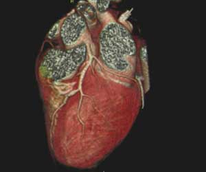 In which cases of CAD, accuracy of Coronary CT Angiography is highest, finds study