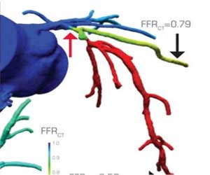 FFR-CT superior to conventional CT angiogram for predicting heart disease