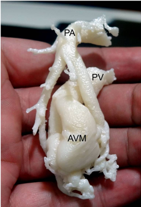Role of 3-D Printing in surgical management of cardiovascular diseases- Dr Harinder Singh Bedi