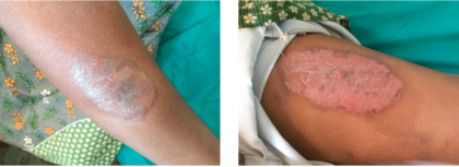 Ayurvedic regimen cured psoriasis vulgaris: Case report