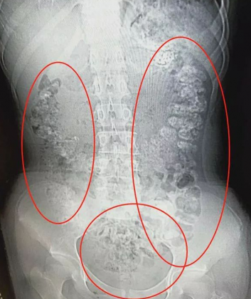 CT scan detects 100 undigested tapioca pearls in teens abdomen: Case report