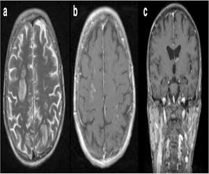 CNS involvement in a patient with primary Sjögren’s syndrome: a case report