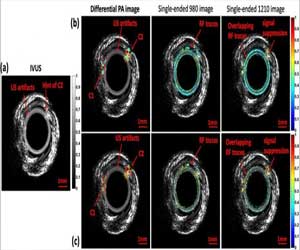 Intravascular photoacoustic imaging may target cholesterol in arterial plaque