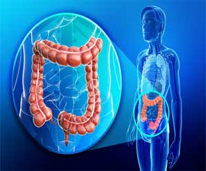 SSI risk after colorectal surgery can be reduced by using oral antibiotic preparation alone