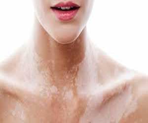 Topical cream ruxolitinib shows promise in vitiligo, finds clinical trial