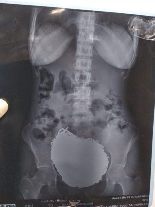 Whopping 1.5 kgs ornaments and coins retrieved from stomach of a mentally compromised woman