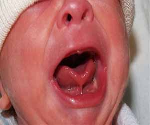 Tongue-tie surgery for improving breastfeeding not always needed: JAMA Study