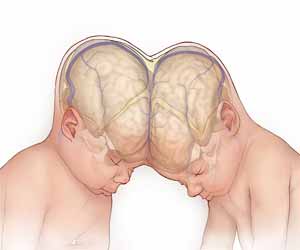 Craniopagus twins