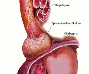 Mumbai Doctors successfully treat Epiphrenic diverticula and Achalasia with Laparoscopy