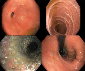 Rare case of Candida pericarditis in an immunocompetent adult: a report