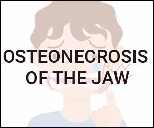 Medication-Related Osteonecrosis of the Jaw: MASCC/ISOO/ASCO Clinical Practice Guideline