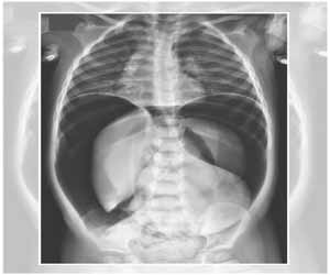 Pneumoperitoneum from a Gastric Perforation in young child: Case study