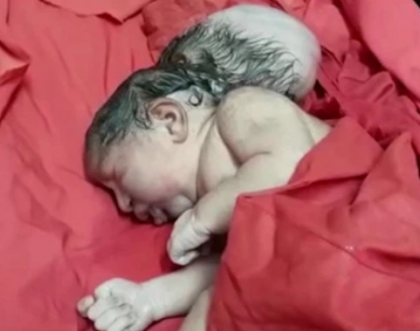 Baby born in UP with three heads