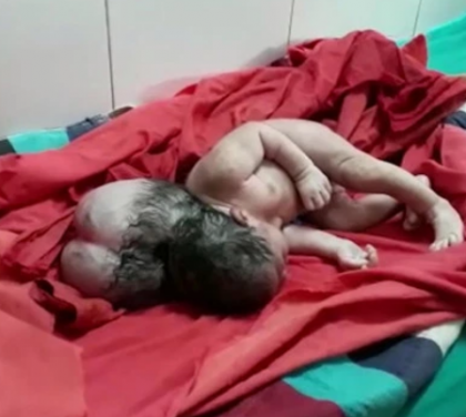 Rare Case of Encephalocele reported: Baby girl born with three heads in UP