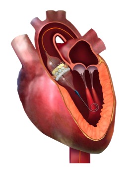 New Self-expanding TAVR Prosthesis not non inferior compared to SAPIEN 3 TAVR device: Lancet