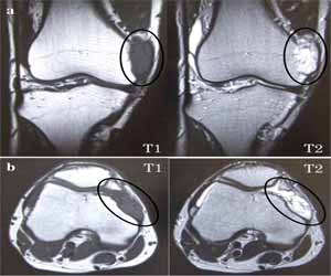 Rare case of undiagnosed synovial hemangioma of the knee: a report