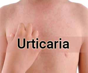 For treatment of chronic spontaneous urticaria methotrexate not superior to placebo