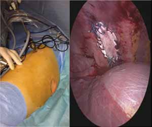 Rare case of isolated congenital inter-costal pulmonary hernia: a report