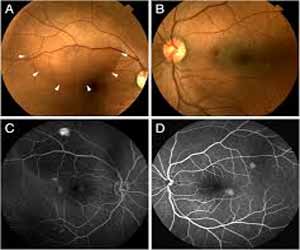 Central serous retinopathy associated with topical oral steroid gel use: a case report