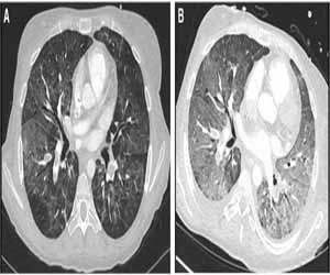 Case of Pulmonary edema secondary to severe hypalbuminemia in a young woman: a case report